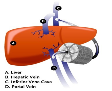 Artificial liver